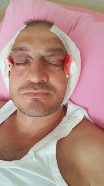 Adem Çebi Migren Ameliyatı Oldu.